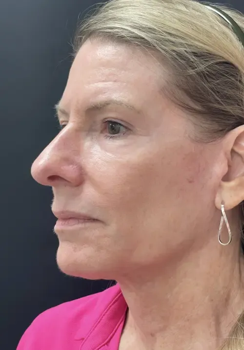 Facelift after — Face & Neck Lift and Phenol Peel around the eyes, nose and mouth