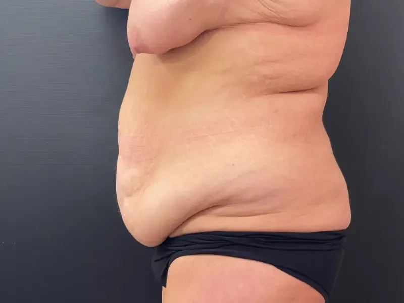 Mommy Makeover before — Mommy Makeover: Breast Lift with 310cc Augmentation and Tummy Tuck, view 3