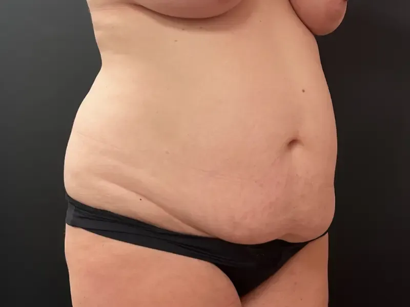 Tummy Tuck and Liposuction before — Liposuction and Tummy Tuck, 6 Months After, view 2