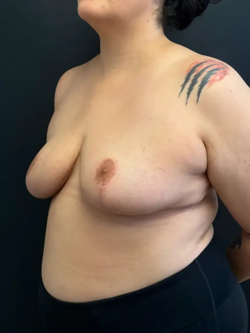 Breast Reduction after — Breast Reduction, view 2