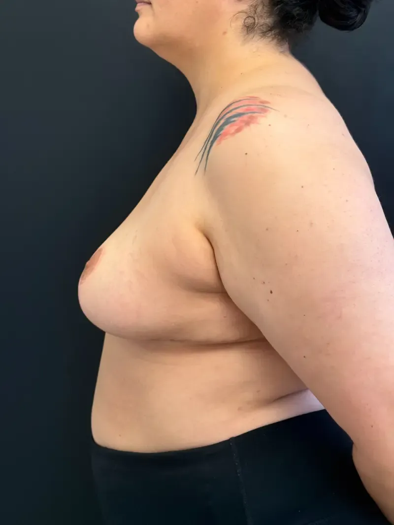 Breast Reduction after — Breast Reduction, view 3