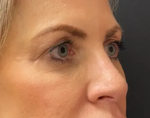 Blepharoplasty before — Upper Blepharoplasty, view 3