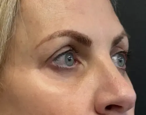 Blepharoplasty after — Upper Blepharoplasty, view 3