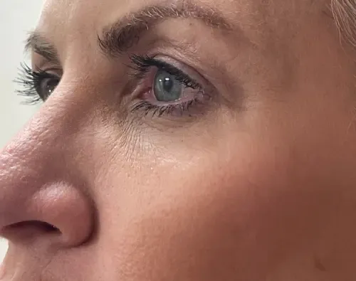 Blepharoplasty before — Upper Blepharoplasty, view 2