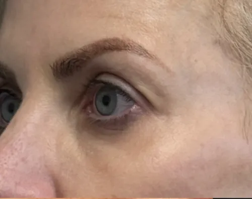 Blepharoplasty after — Upper Blepharoplasty, view 2