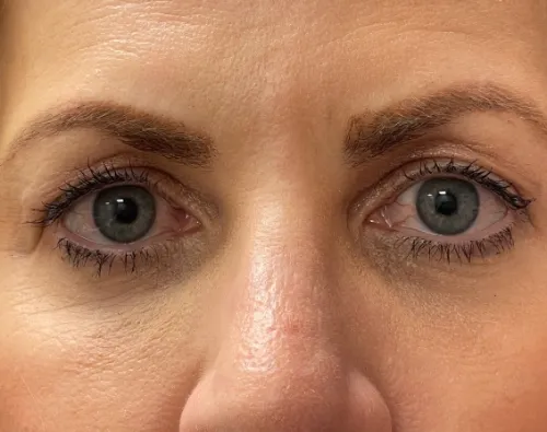 Blepharoplasty before — Upper Blepharoplasty, view 1