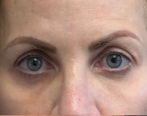 Blepharoplasty after — Upper Blepharoplasty, view 1