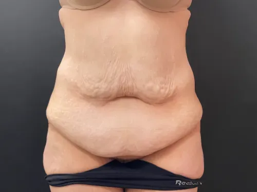 Tummy tuck patient 3, before surgery