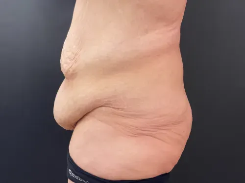Tummy Tuck and Liposuction before — Tummy Tuck, view 3