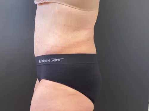 Tummy Tuck and Liposuction after — Tummy Tuck, view 3