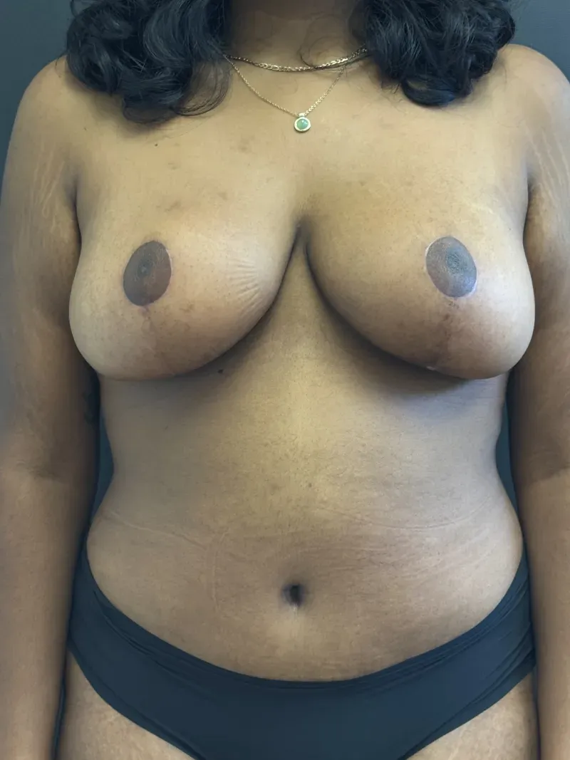 Mommy Makeover after — Mommy Makeover: Breast Lift and Tummy Tuck