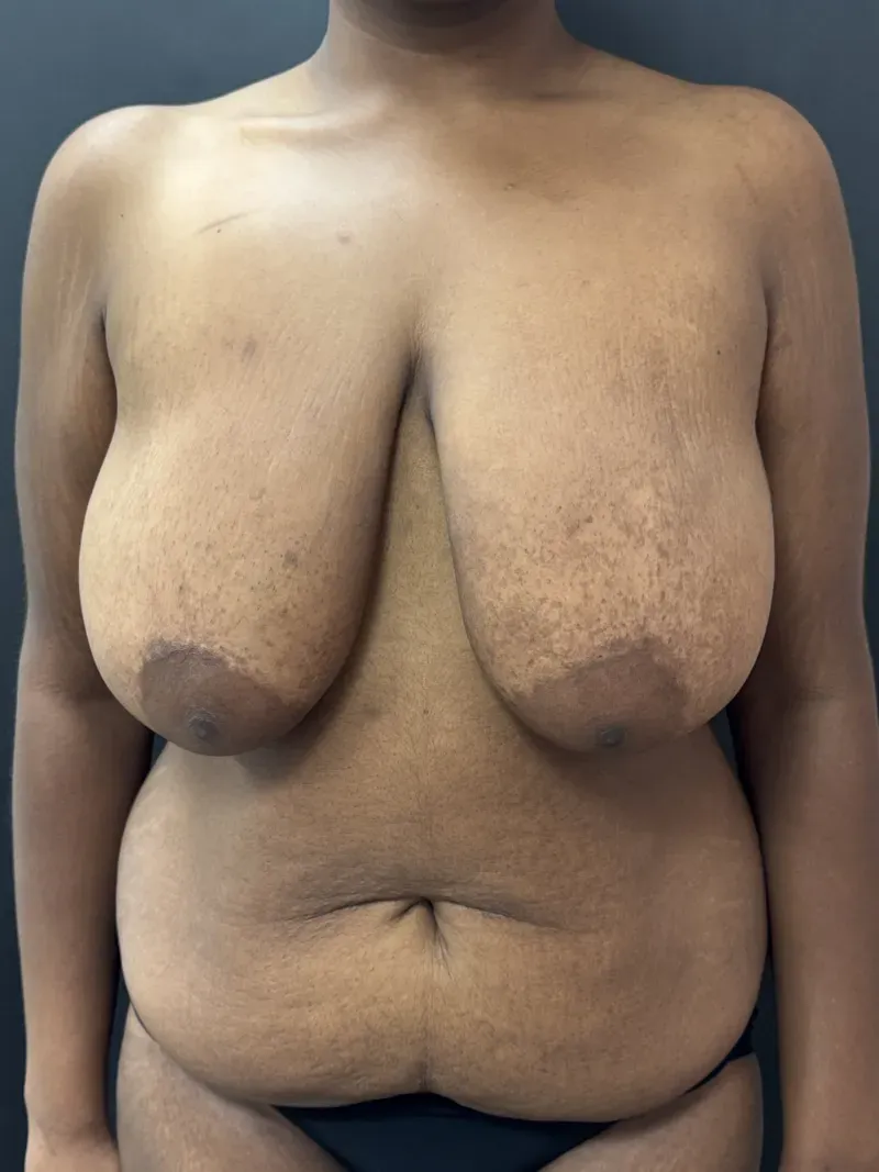 Mommy Makeover before — Mommy Makeover: Breast Lift and Tummy Tuck