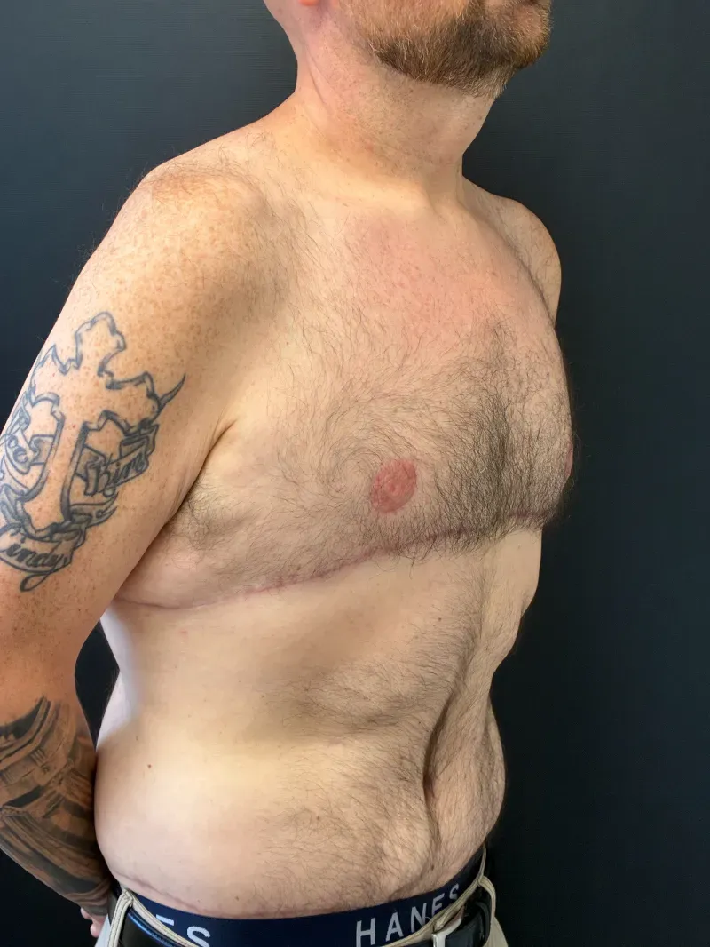 Gynecomastia after — Gynecomastia, view 2