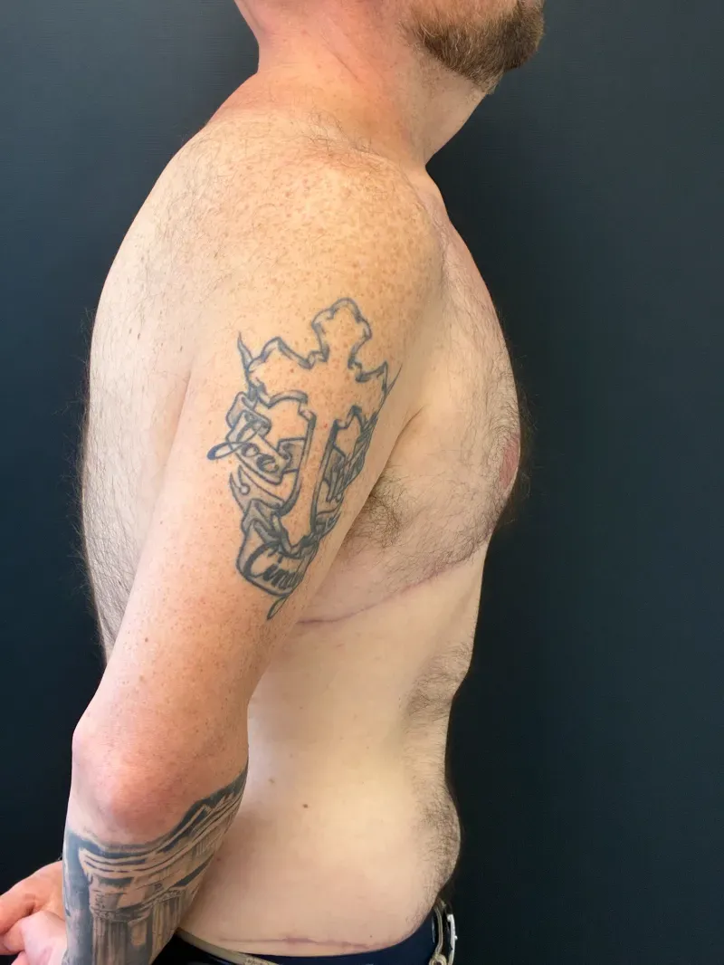 Gynecomastia after — Gynecomastia, view 3
