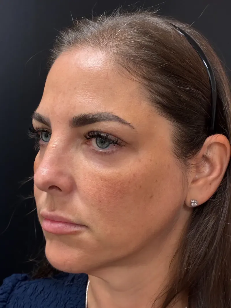 Facelift before — Face and Neck Lift, view 2