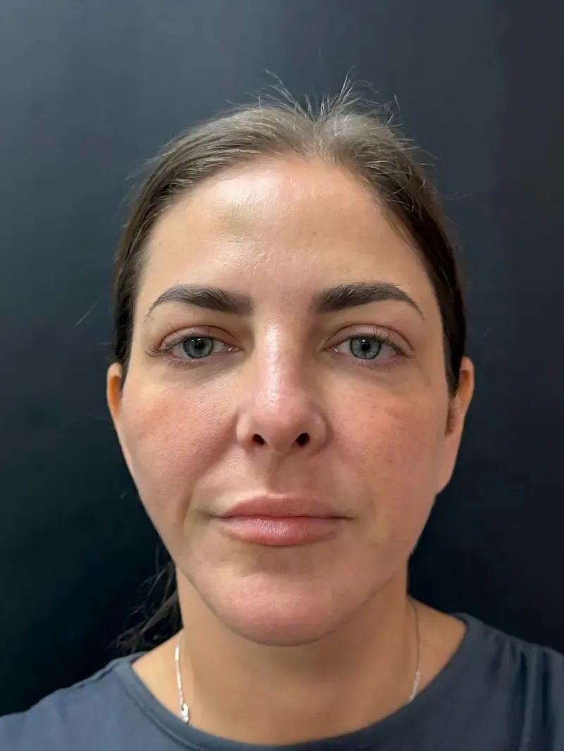 Facelift after — Face and Neck Lift, view 1