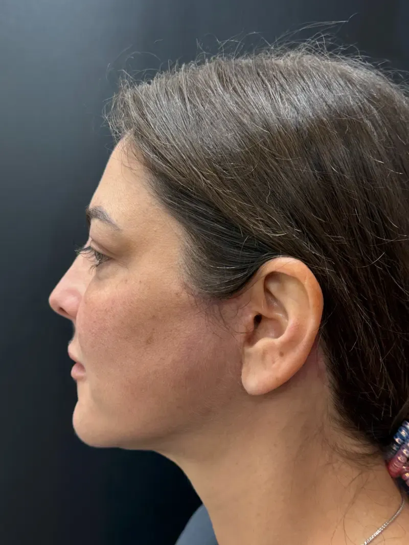 Facelift after — Face and Neck Lift, view 3