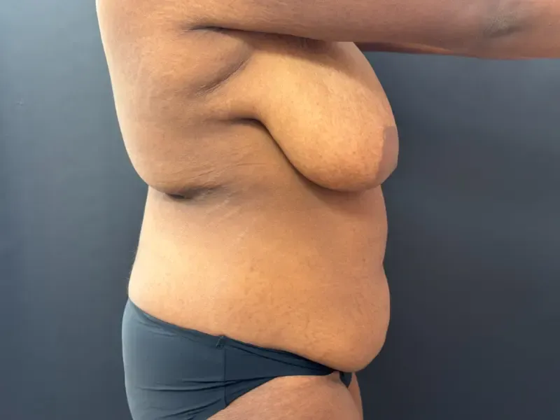 Breast Reduction before — Breast Reduction, view 3