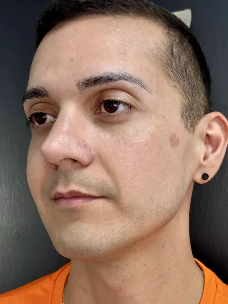 BBL Photorejuvenation before — BBL + HALO™, view 2