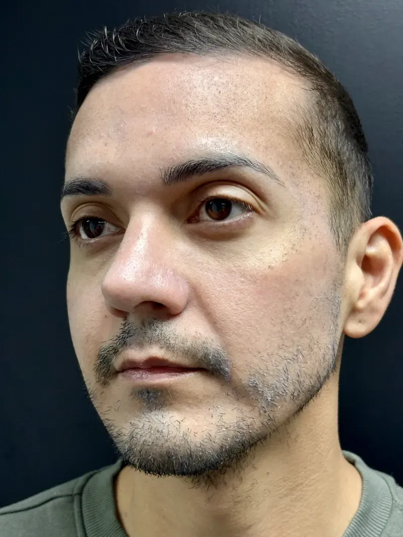 BBL Photorejuvenation after — BBL + HALO™, view 2