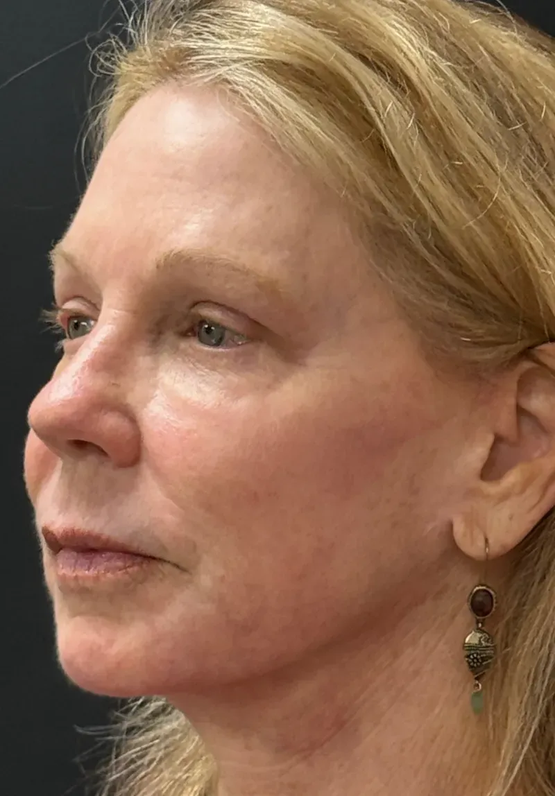 Laser Skin Resurfacing after — Deep Sciton Erbium Laser Resurfacing