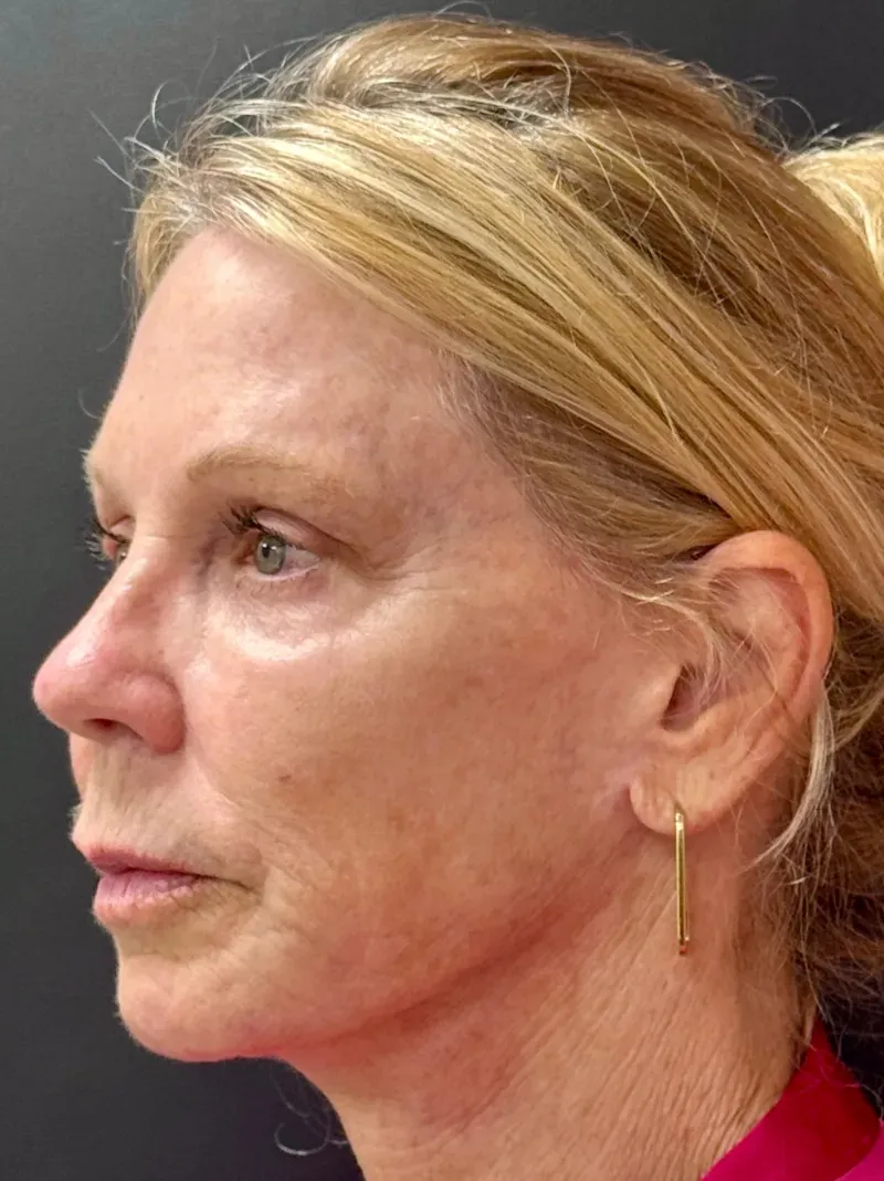 Laser Skin Resurfacing before — Deep Sciton Erbium Laser Resurfacing