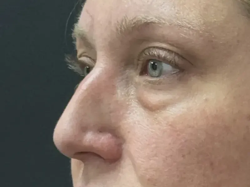 Blepharoplasty before — Upper and Lower Blepharoplasty, view 2