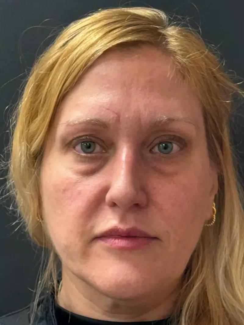 Blepharoplasty before — Upper and Lower Blepharoplasty, view 1