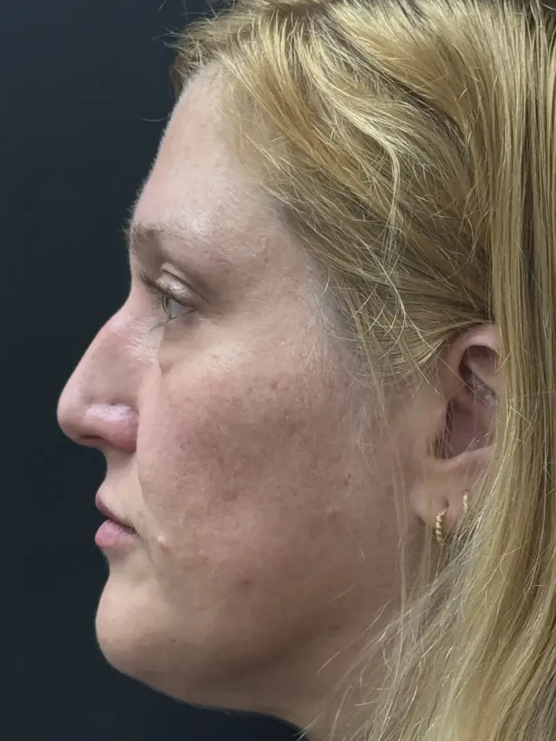 Blepharoplasty before — Upper and Lower Blepharoplasty, view 3