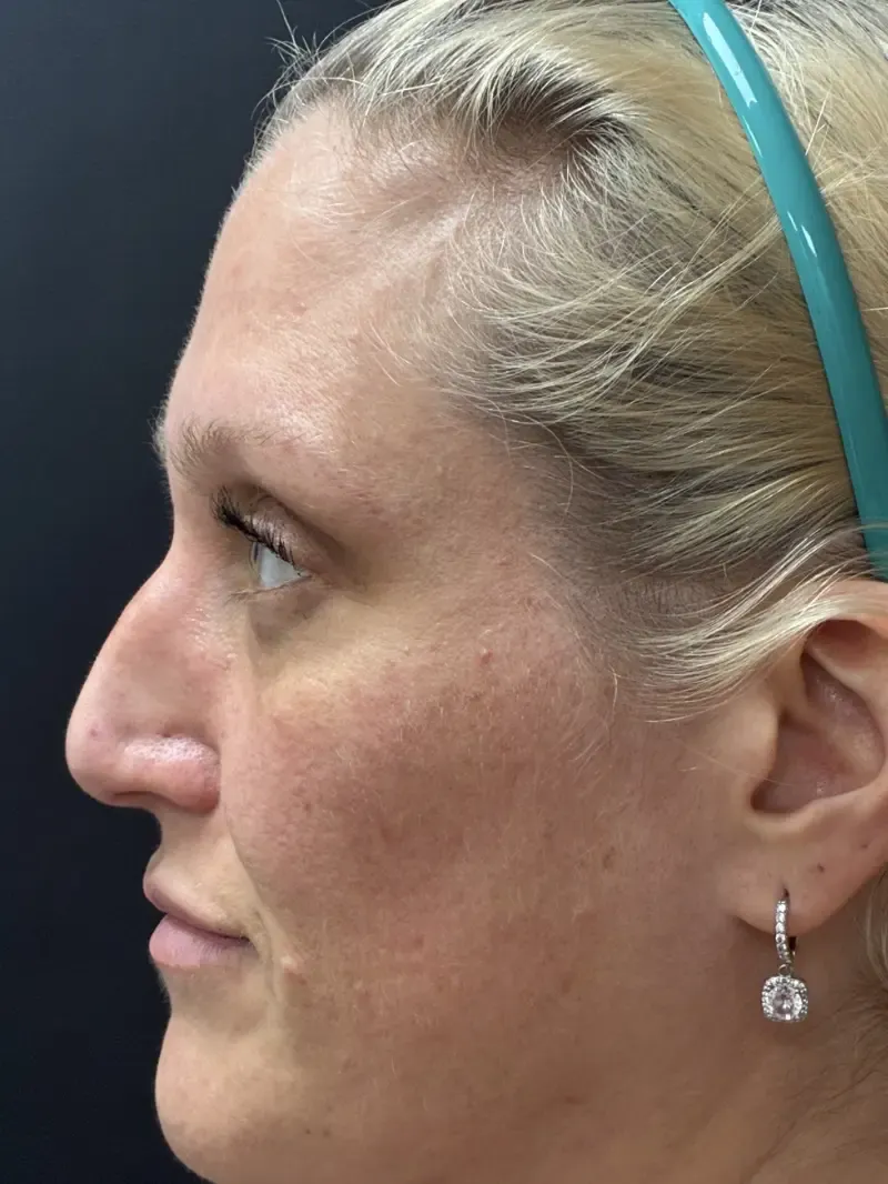 Blepharoplasty after — Upper and Lower Blepharoplasty, view 3