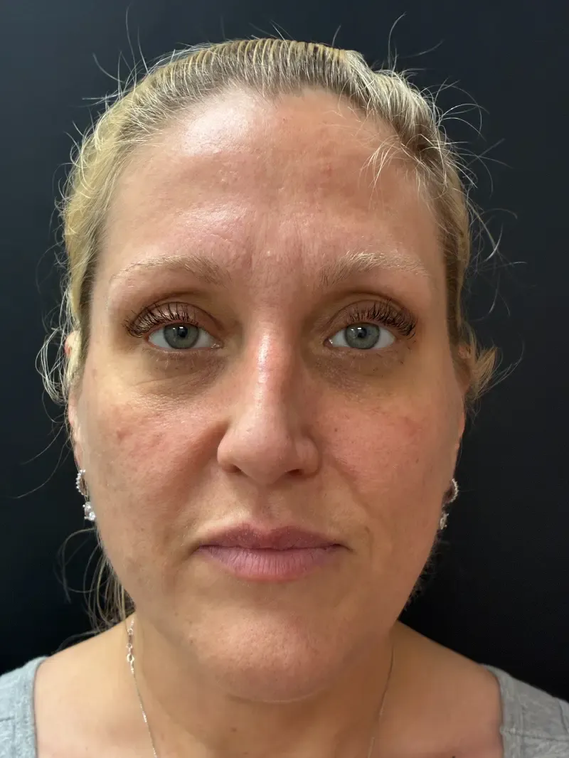 Blepharoplasty after — Upper and Lower Blepharoplasty, view 1