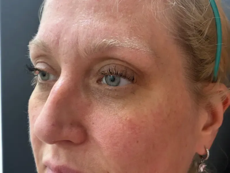 Blepharoplasty after — Upper and Lower Blepharoplasty, view 2