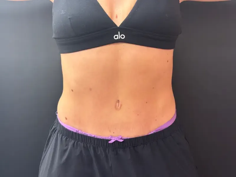 Tummy Tuck and Liposuction after — Tummy Tuck, view 1