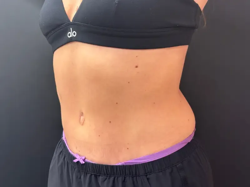 Tummy Tuck and Liposuction after — Tummy Tuck, view 2