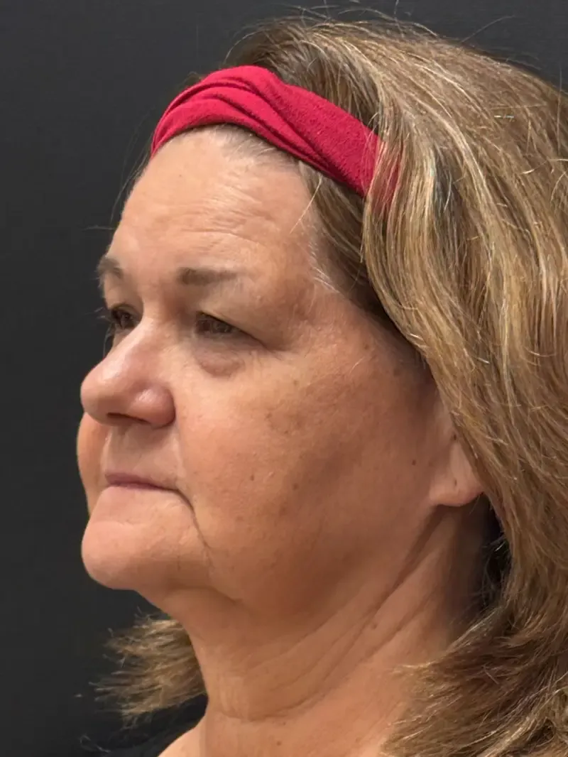 Blepharoplasty before — Upper and Lower Blepharoplasty, view 2