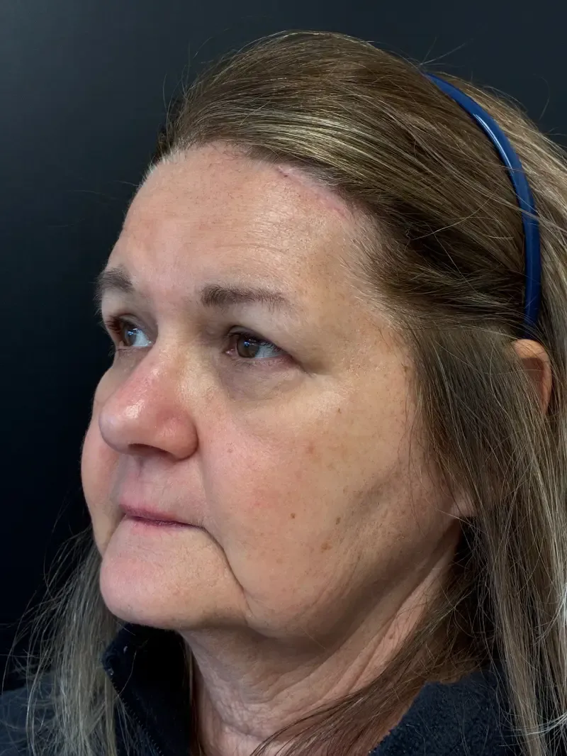 Blepharoplasty after — Upper and Lower Blepharoplasty, view 2