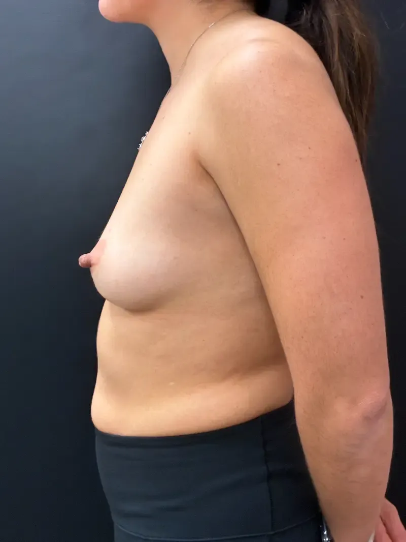 Breast Augmentation before — Breast Augmentation 340cc Motiva Ergonomix Demi, view 3
