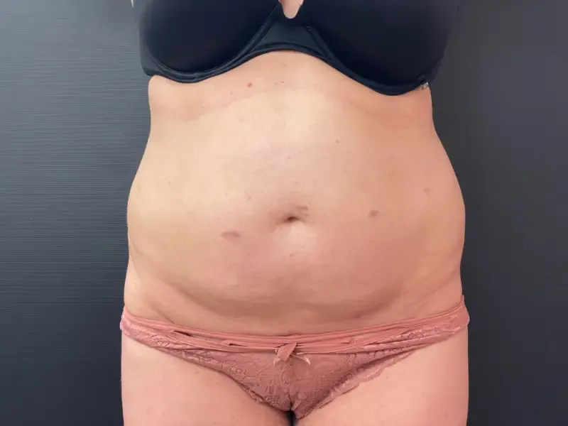 Tummy tuck patient 1, before surgery