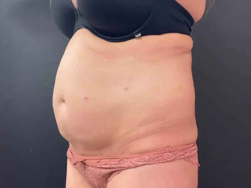 Tummy Tuck and Liposuction before — Tummy Tuck, view 2