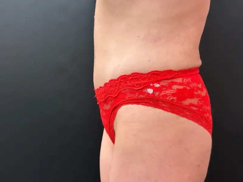 Tummy Tuck and Liposuction after — Tummy Tuck, view 3