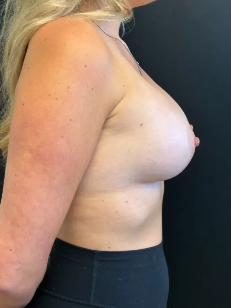 Breast Augmentation after — Breast Augmentation 340cc Motiva Ergonomix Demi, view 3
