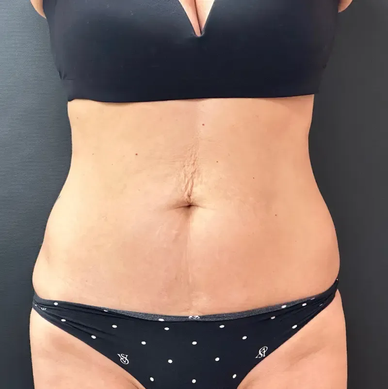 Tummy Tuck and Liposuction before — Tummy Tuck, view 1