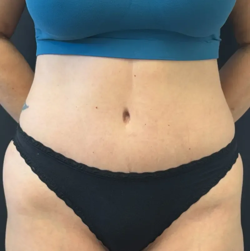 Tummy Tuck and Liposuction after — Tummy Tuck, view 1