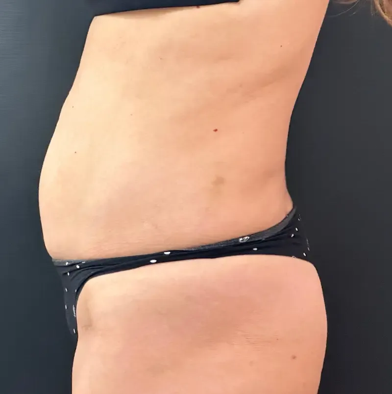 Tummy Tuck and Liposuction before — Tummy Tuck, view 3