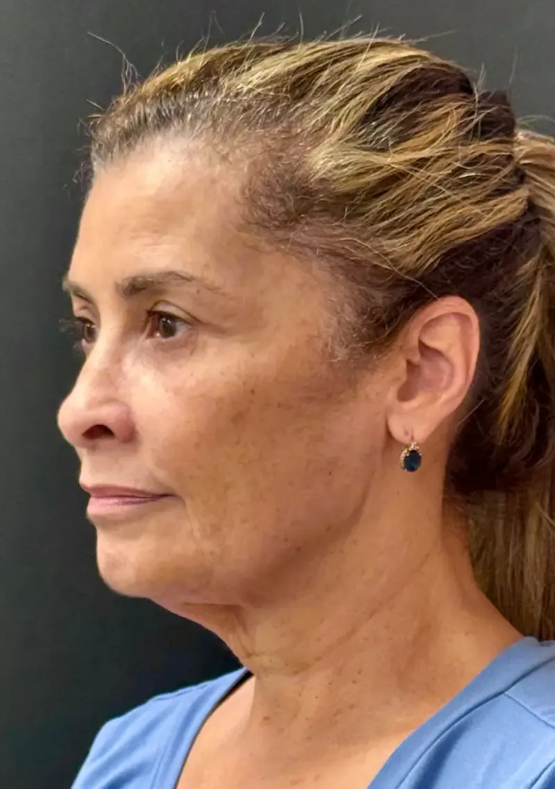 Facelift before — Face and Neck Lift with Fat Grafting and Moxi Laser Resurfacing, view 2