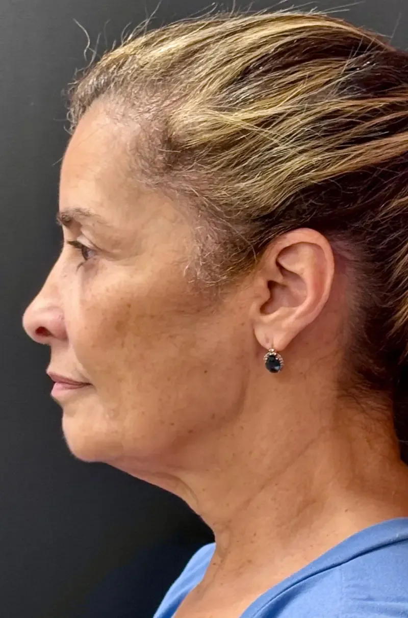 Facelift before — Face and Neck Lift with Fat Grafting and Moxi Laser Resurfacing, view 3