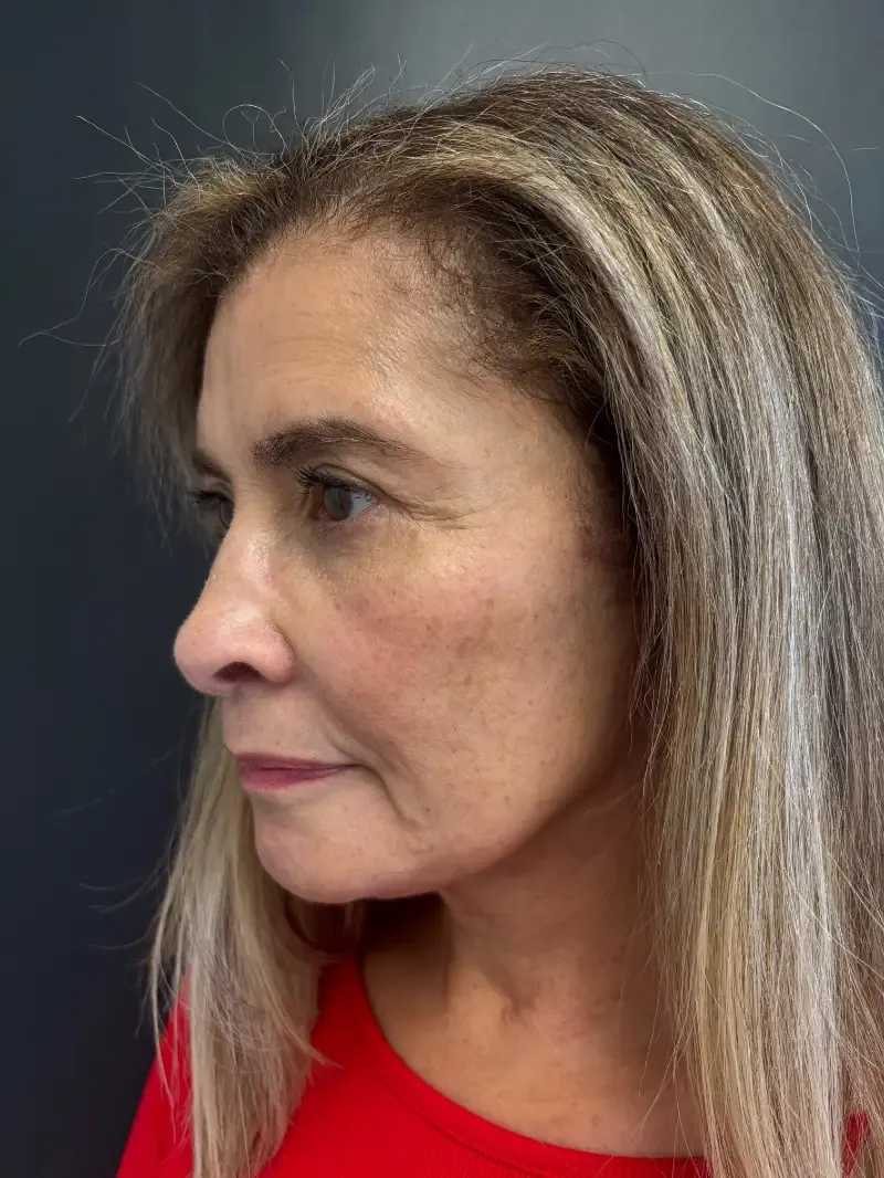 Facelift after — Face and Neck Lift with Fat Grafting and Moxi Laser Resurfacing, view 2