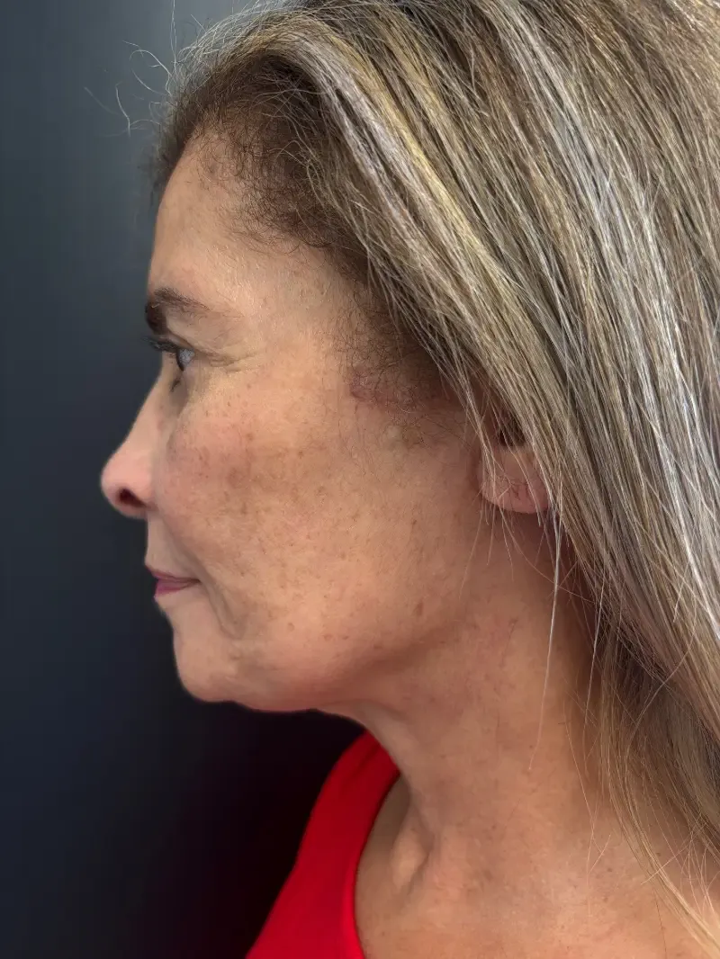 Facelift after — Face and Neck Lift with Fat Grafting and Moxi Laser Resurfacing, view 3