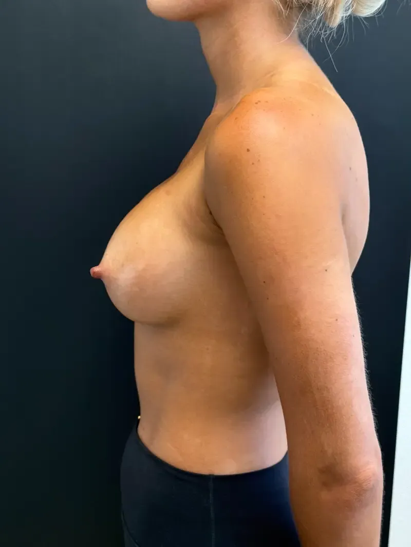 Breast Augmentation after — Breast Augmentation 360cc Motiva Round Demi, view 3
