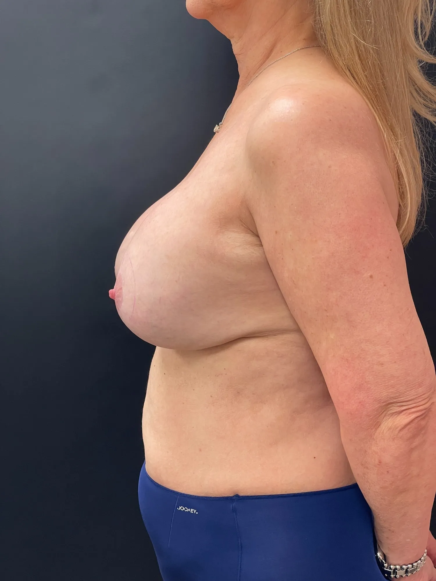 Breast Implant Exchange before — Breast Implant Removal and Replacement with Total Capsulectomy (for Grade 4 Capsular Contracture), view 3